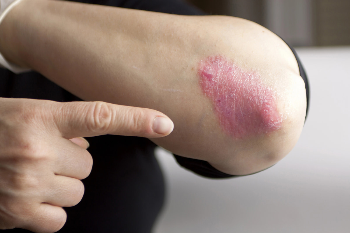 Codo con brote de psoriasis